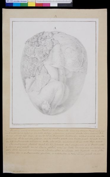 M Houtman, Foetus