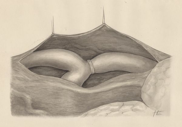 J Tinkelenberg, Part of the heart and circulatory system
