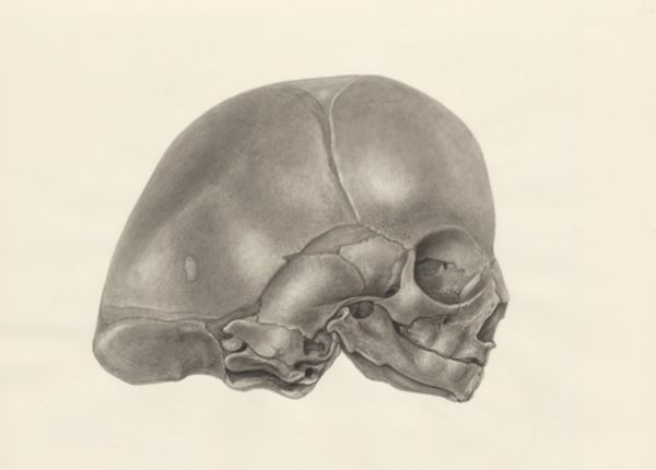 H.G Wetselaar, Deformed fetal skull
