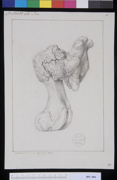 M. Houtman, Pathology, fractures (Femur)