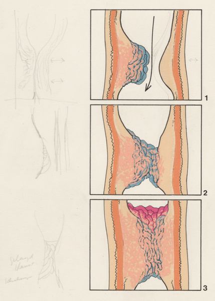 J Tinkelenberg, Part of the heart and circulatory system