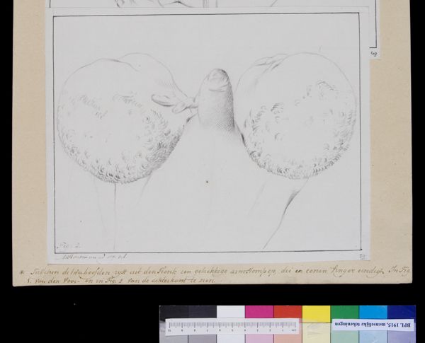 M Houtman, Conjoined twins