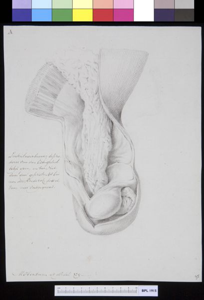 M Houtman, Inguinal hernia