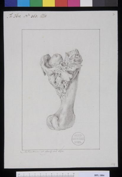 M. Houtman, Pathology, fractures (Femur)