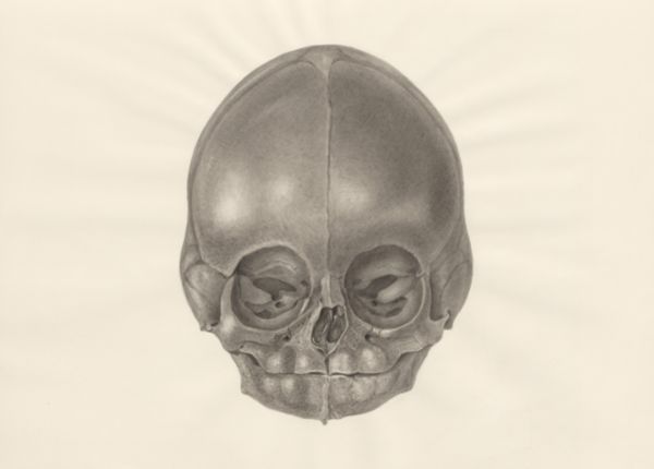 H.G Wetselaar, Deformed fetal skull