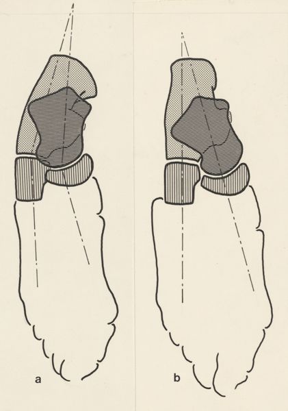J Tinkelenberg, Schematic representation of the feet