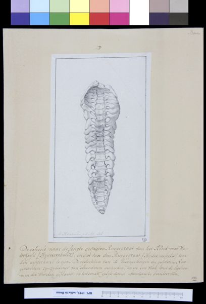 M Houtman, Vertebrae of child with hydrocephalus