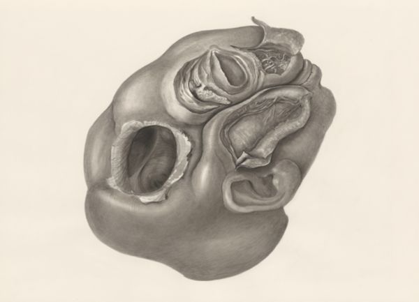 H.G Wetselaar, Deformed fetal head, lateral view