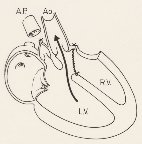 J Tinkelenberg, Thorax surgery