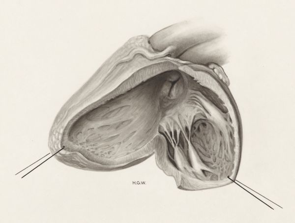H.G Wetselaar, Heart