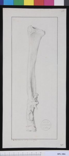 M Houtman, Pathology, fractures (Forearm)