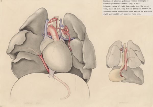 J Tinkelenberg, Heart and adjacent organs