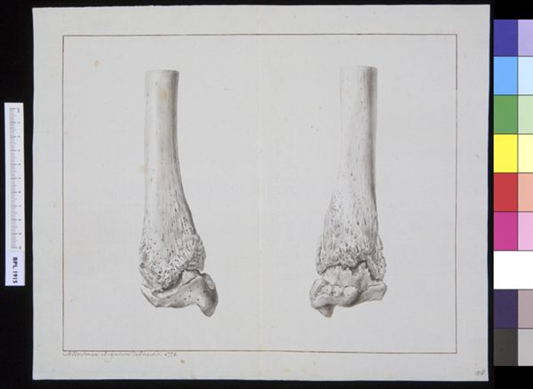 M Houtman, Infected bones