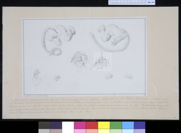 M. Houtman, Views of a deformed foetus with umbilical cord