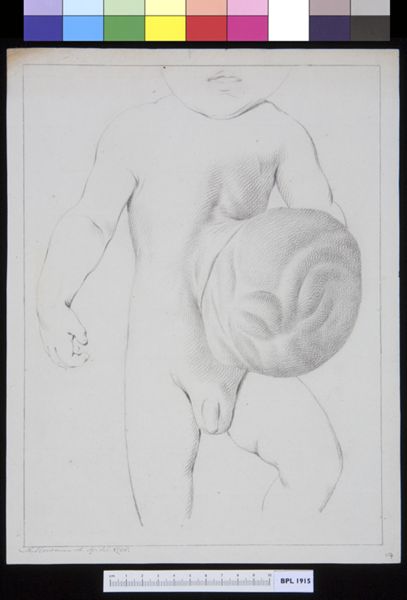 M Houtman, Hernia on a child's body