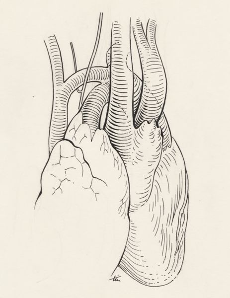 J Tinkelenberg, Aortic surgery