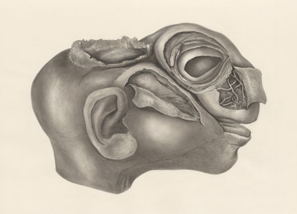 H.G Wetselaar, Deformed fetal head, lateral view