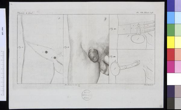 M Houtman, Pathology, fractures