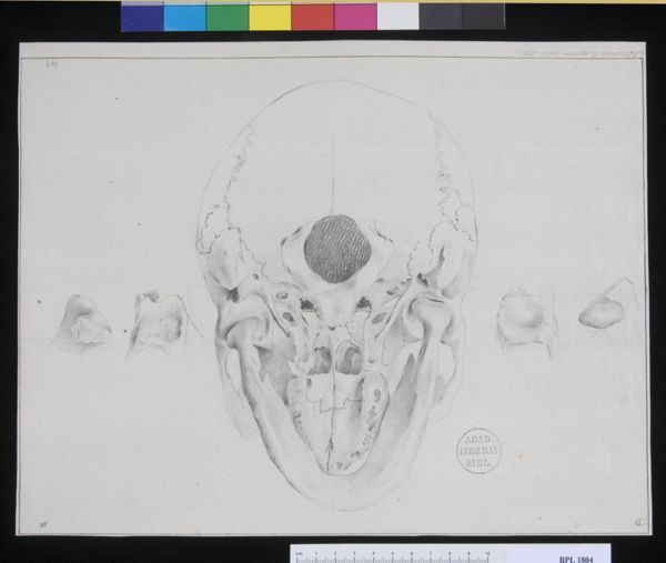 M Houtman, Pathology, fractures