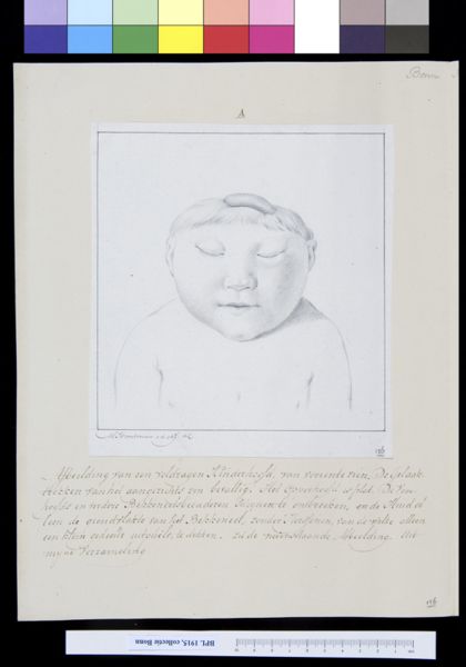 M Houtman, Deformed child