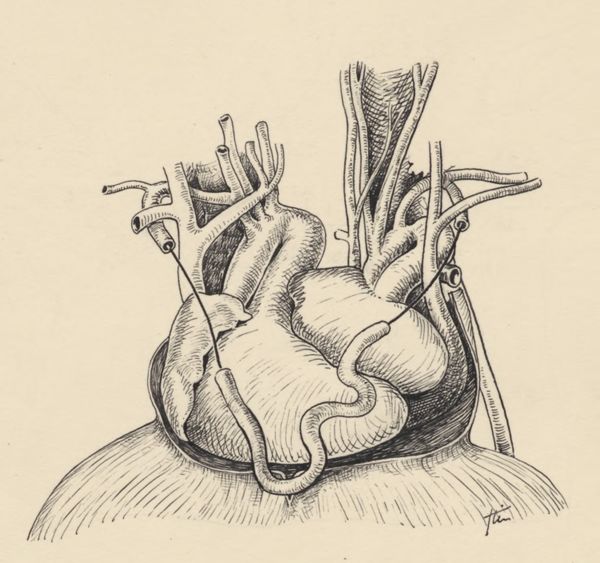 J Tinkelenberg, Part of the heart and circulatory system