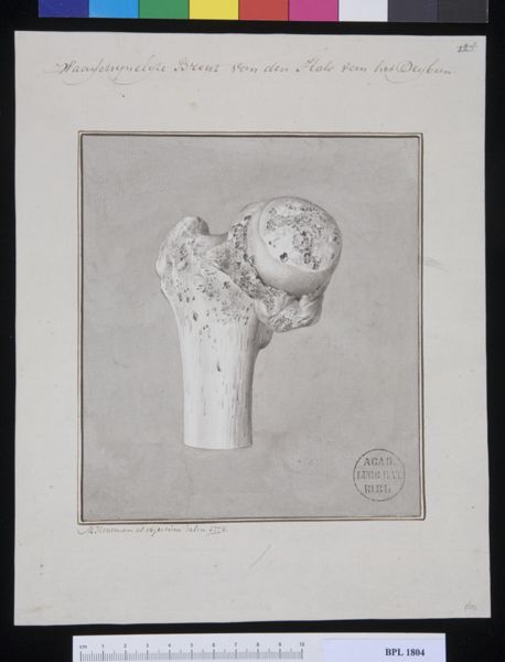 M Houtman, Pathology, fractures (Femur and hip)