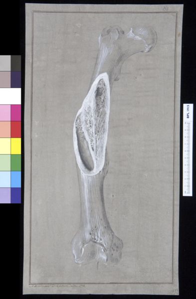 M Houtman, Infected bone