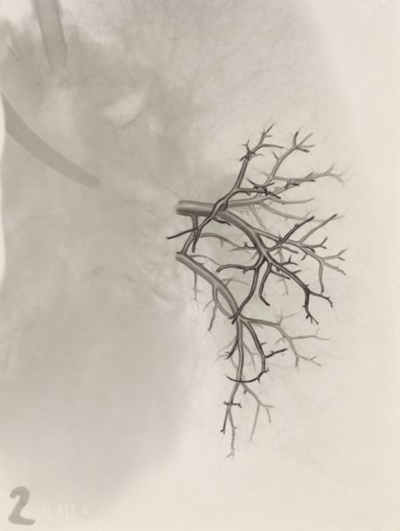 J Tinkelenberg, Bronchi