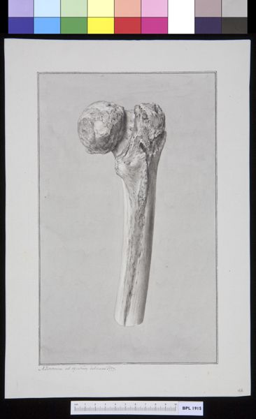 M Houtman, Infected bone (femur)