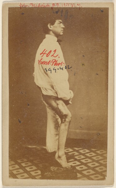 Unknown, No. 2. Case of John Frederick U.S.V. Side View. [Civil War victim]