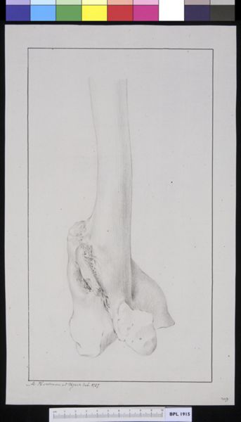 M Houtman, Femur or fibula with fracture