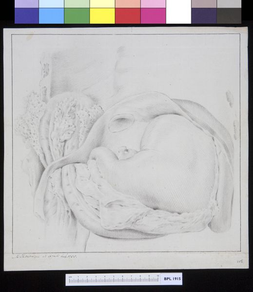 M Houtman, Hernia
