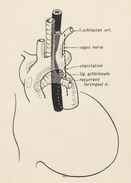 J Tinkelenberg, Heart