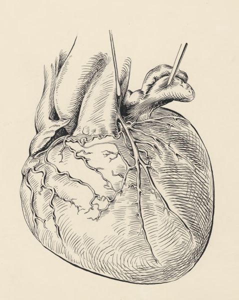 J Tinkelenberg, Heart