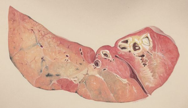 J Wetselaar-Whittaker, Lung tissue