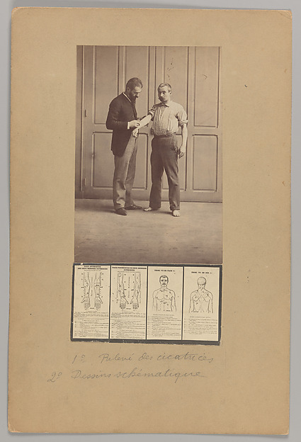 Alphonse Bertillon, Notation of Scars, Schematic Drawings