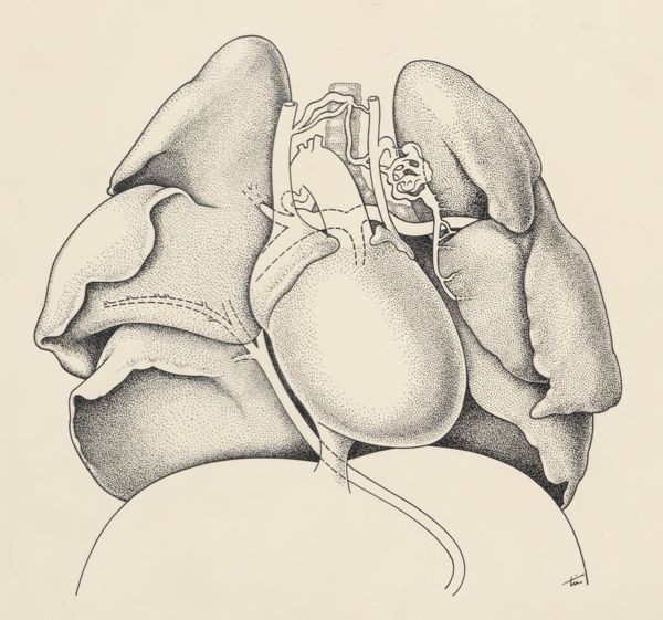 J Tinkelenberg, Heart and adjacent organs
