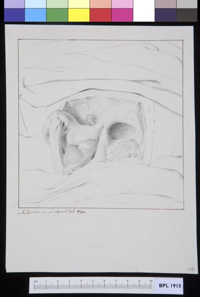 M. Houtman, Hernia