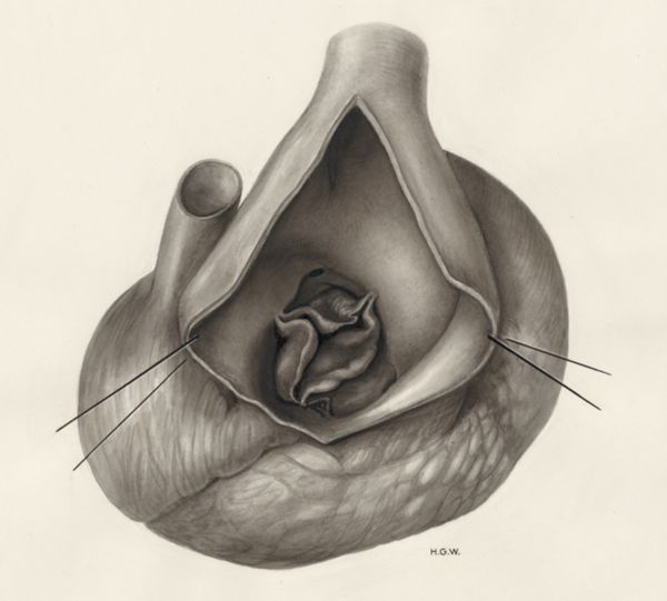 H.G Wetselaar, Heart