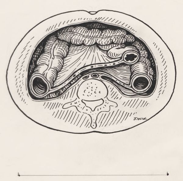 J Tinkelenberg, Tissue relating to the throat