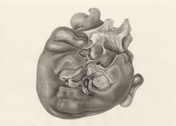 H.G Wetselaar, Deformed fetal head