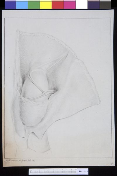 M Houtman, Inguinal hernia