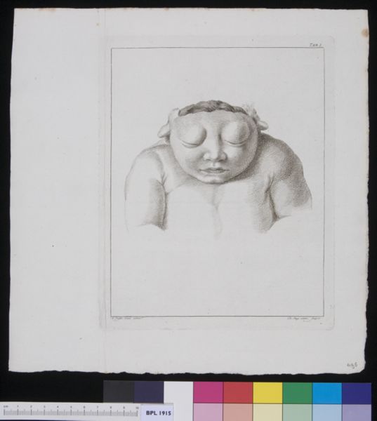 R Muys, Child with deformed head, frontal view