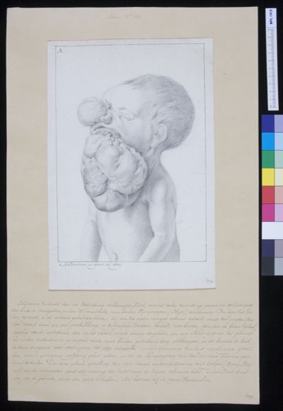 M Houtman, Child with tumor through nose and mouth