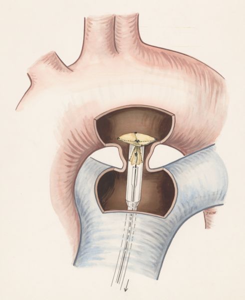 J Wetselaar-Whittaker, Procedure to open the artery around the heart of young children, devised by Dr. J. Rohmer