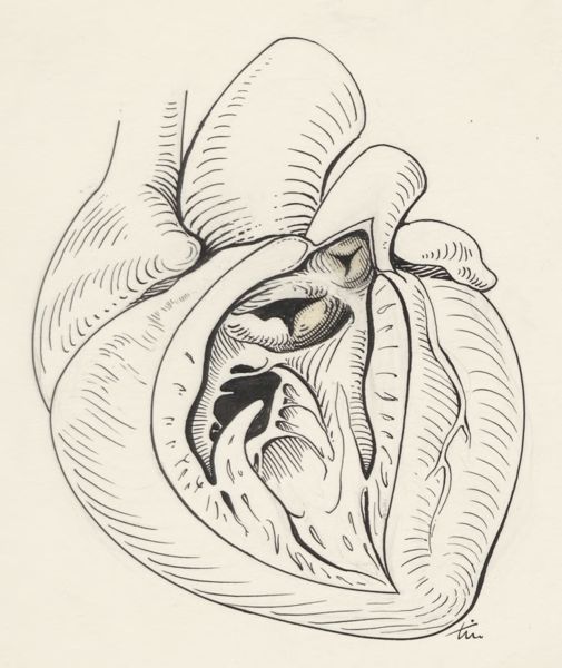 J Tinkelenberg, Heart
