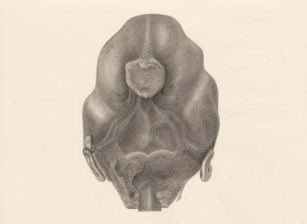 H.G Wetselaar, Deformed fetal head, seen from the back