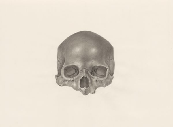 H.G Wetselaar, Deformed skull