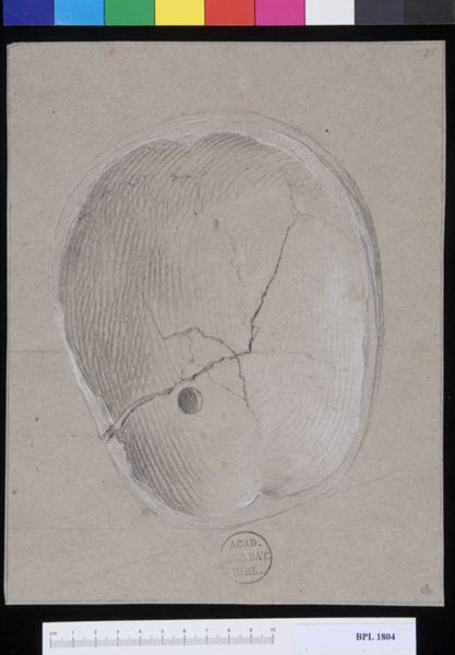 M Houtman, Pathology, fractures (Fractured skull, interior view)