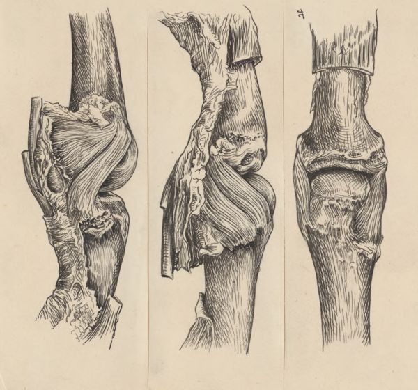 J Tinkelenberg, Joints of the hand or fingers